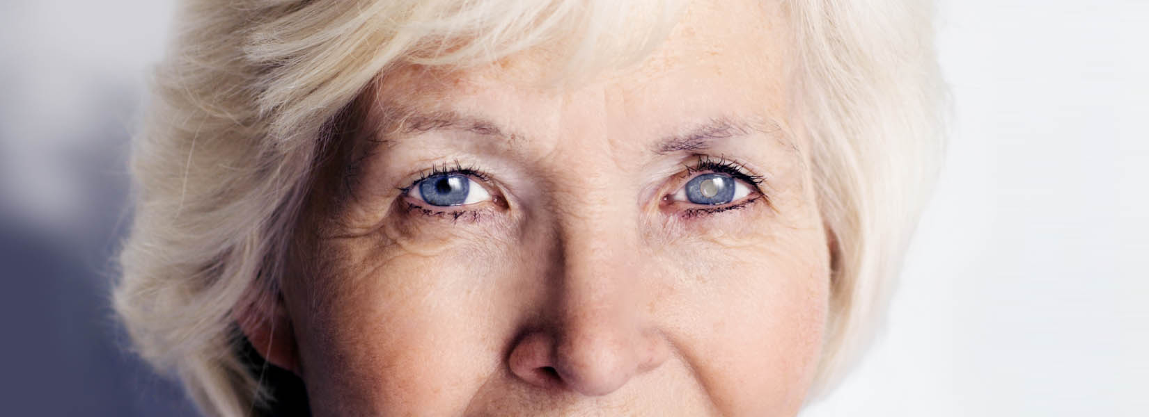 Cataract Surgery in Ferguson